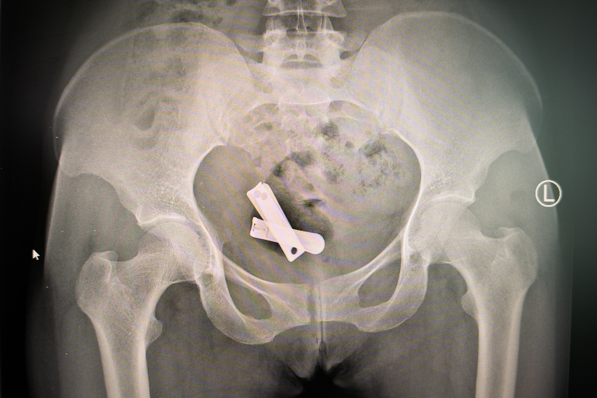 2 - X-ray image showing a nail clipper inserted inside a uterus- Mekele- Tigray- March 202.jpg